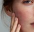 cbd para tratar acne rosacea